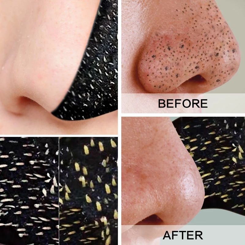 🖤Charcoal Nose Strips 6PCS | Deep Cleansing Blackhead Remover Pore Strips✨